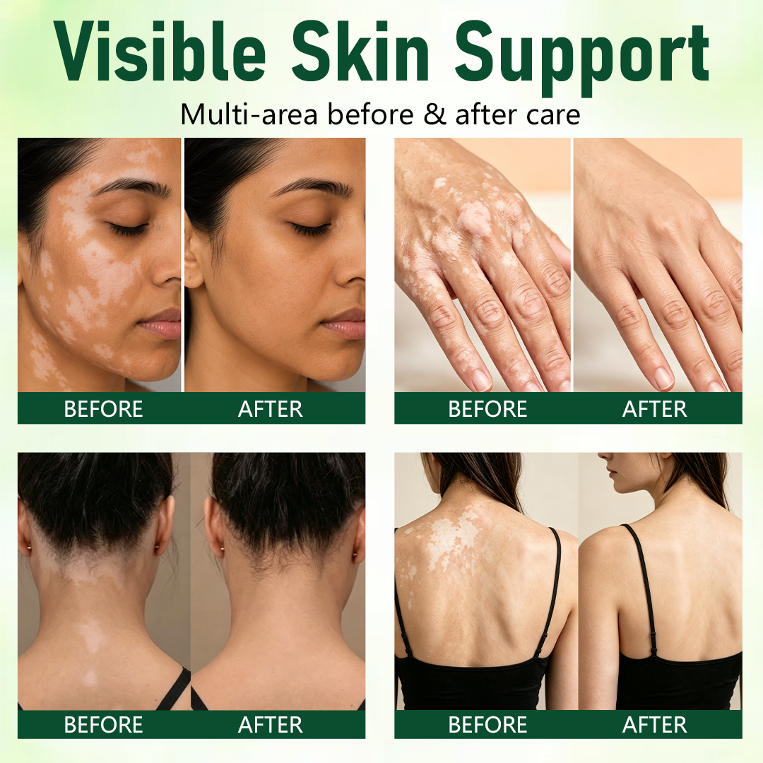 Medazy® Herbal Vitiligo Cream